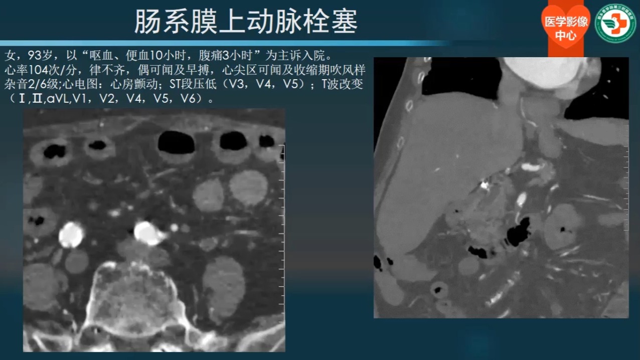 第十四讲、急性肠系膜缺血02（共30讲）