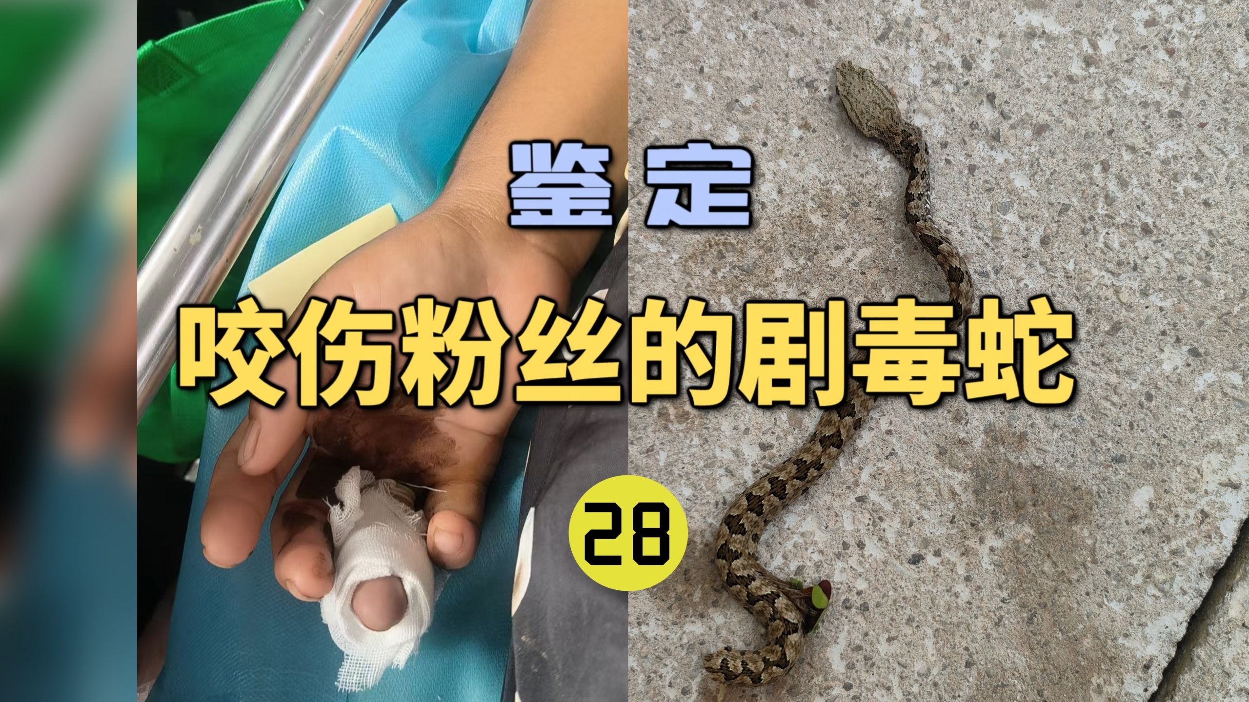 鉴定咬伤粉丝的毒蛇(28)粉丝的家人被五步蛇咬伤！打了血清依旧凝血异常？-世界记忆大师龙雅-世界记忆大师龙雅-哔哩哔哩视频