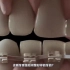 杭州人民口腔 I 正畸科普（一）如何科学的矫正牙齿 转自回形针