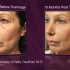How Thermage Skin Tightening Works