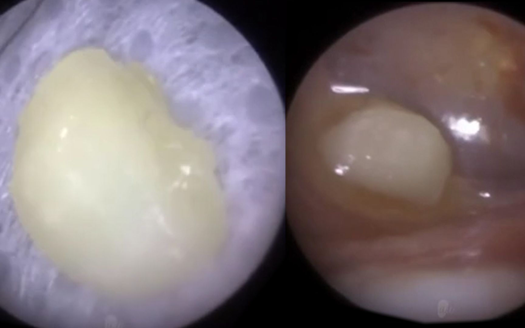 男童因耳疼就医，医生见耳道有一块“死皮”，取出发现是人的牙齿