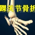 【3D医学动画】踝关节骨折修复（中英双字幕）