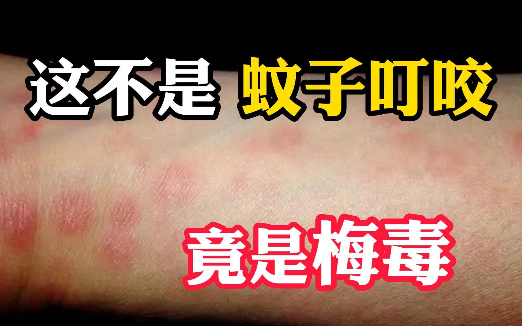 身上这长这种小红点，不是过敏！是梅毒？#皮肤  #健康  #科普
