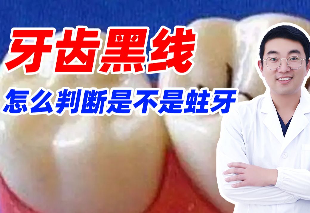 牙齿黑线怎么判断是不是蛀牙，补还是不补？
