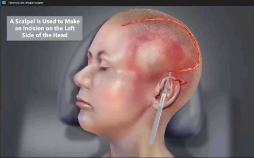 外伤脑出血手术清理过程，3D演示。。