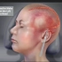 外伤脑出血手术清理过程，3D演示。。