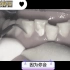 日本男青年第一次洗牙，里面的牙结石全都出来了，女朋友表示接受不了