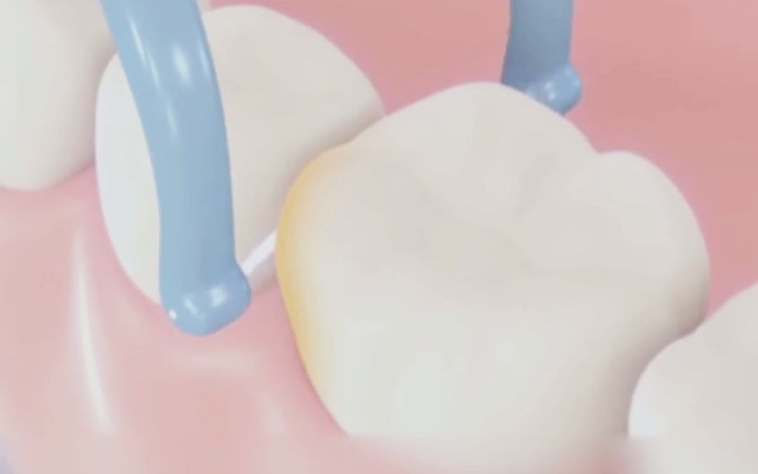 3D演示牙线使用方法