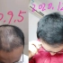 断断续续治疗脱发很多年没效果，这次坚持治疗4个月，奇迹出现了。
