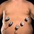 切胃减肥手术过程，3D演示。。