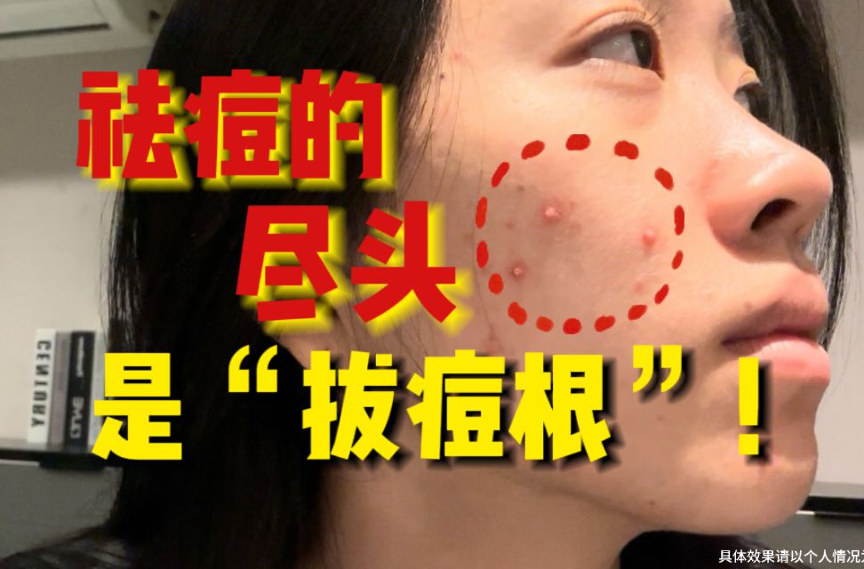 【反复长痘必看】痘根不除！必会反复！