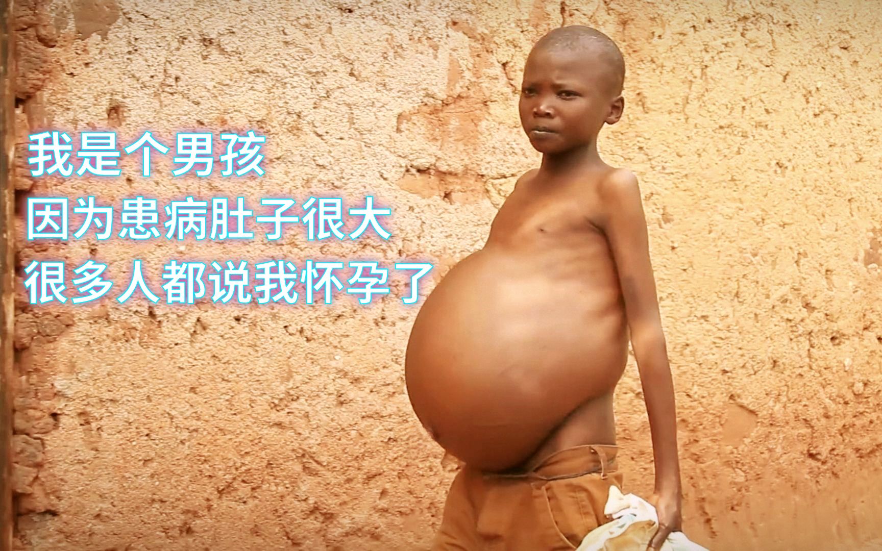大家怎么看:18岁男孩肚子堪比临产孕妇，村里人都说他怀孕了，到底是怎么回事？[一次目更~]的第1张示图