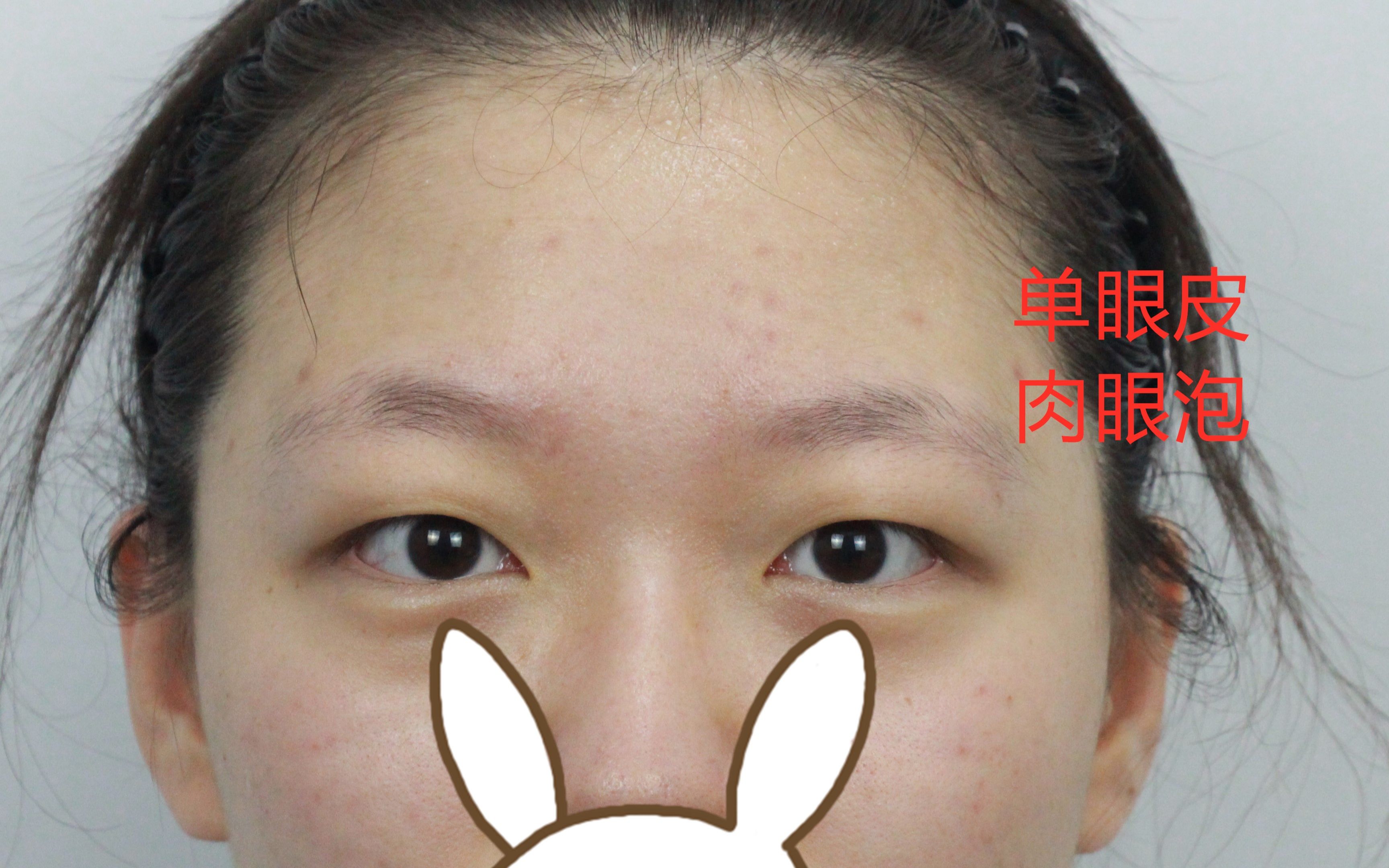 肿眼泡双眼皮恢复记录：郑州90后小姑娘肉眼泡明显，眼睛无神全切开扇双眼皮半年后形态自然。