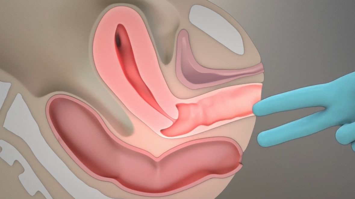 女性盆腔检查 | 医学动画