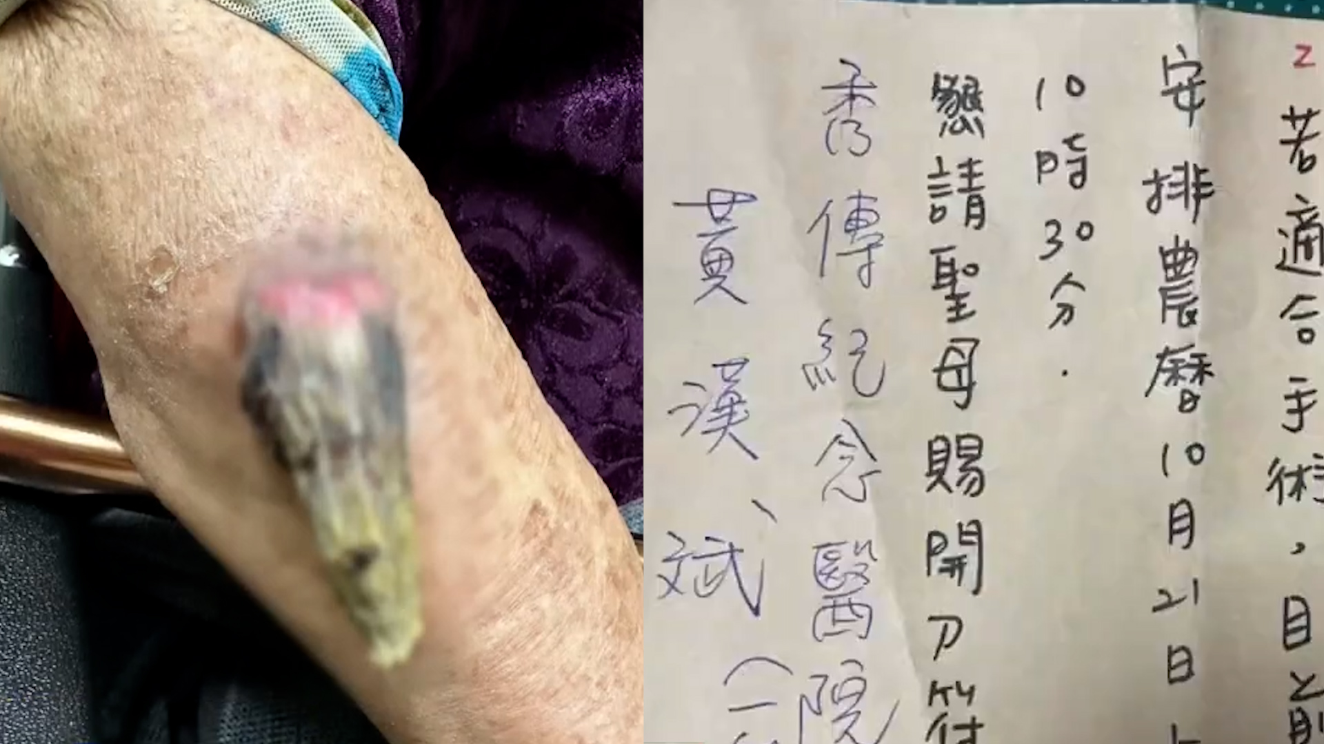 91岁奶奶手臂长7cm“角”，去寺庙被开仙界转诊单，医生道明真相