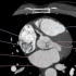 8.心血管影像解剖图谱-左右心腔CT解剖