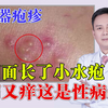 下面长小水疱，又痛又痒这是性病