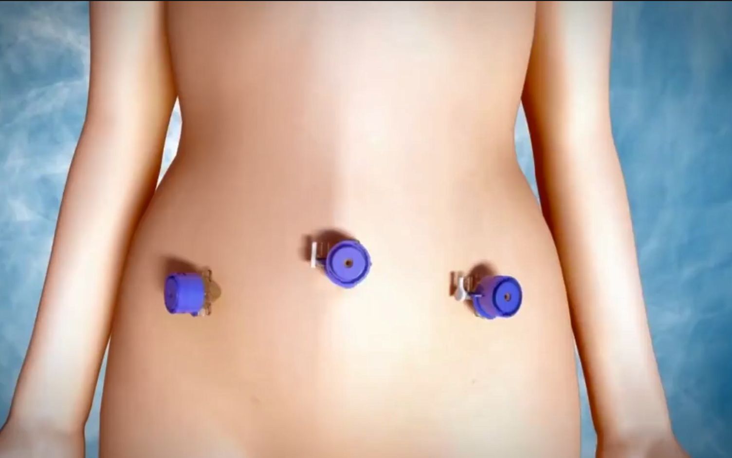 3d医学动画：腹腔镜子宫全切术全过程视频