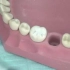 金属全冠的牙体预备过程