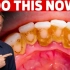 牙菌斑、蛀牙和牙龈炎的第一大最佳疗法