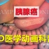 【3D医学动画科普】胰腺癌（中英双语字幕）