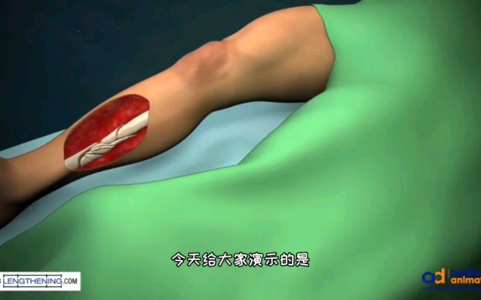 小腿粉碎性骨折手术修复过程，3D演示。。