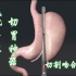 3D演示：减肥手术，袖状胃切除神器
