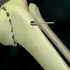 3D视频：先进的医学技术，胫骨骨折微创手术动画视频