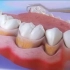 洗牙+龈下刮治全过程！牙周炎的福音