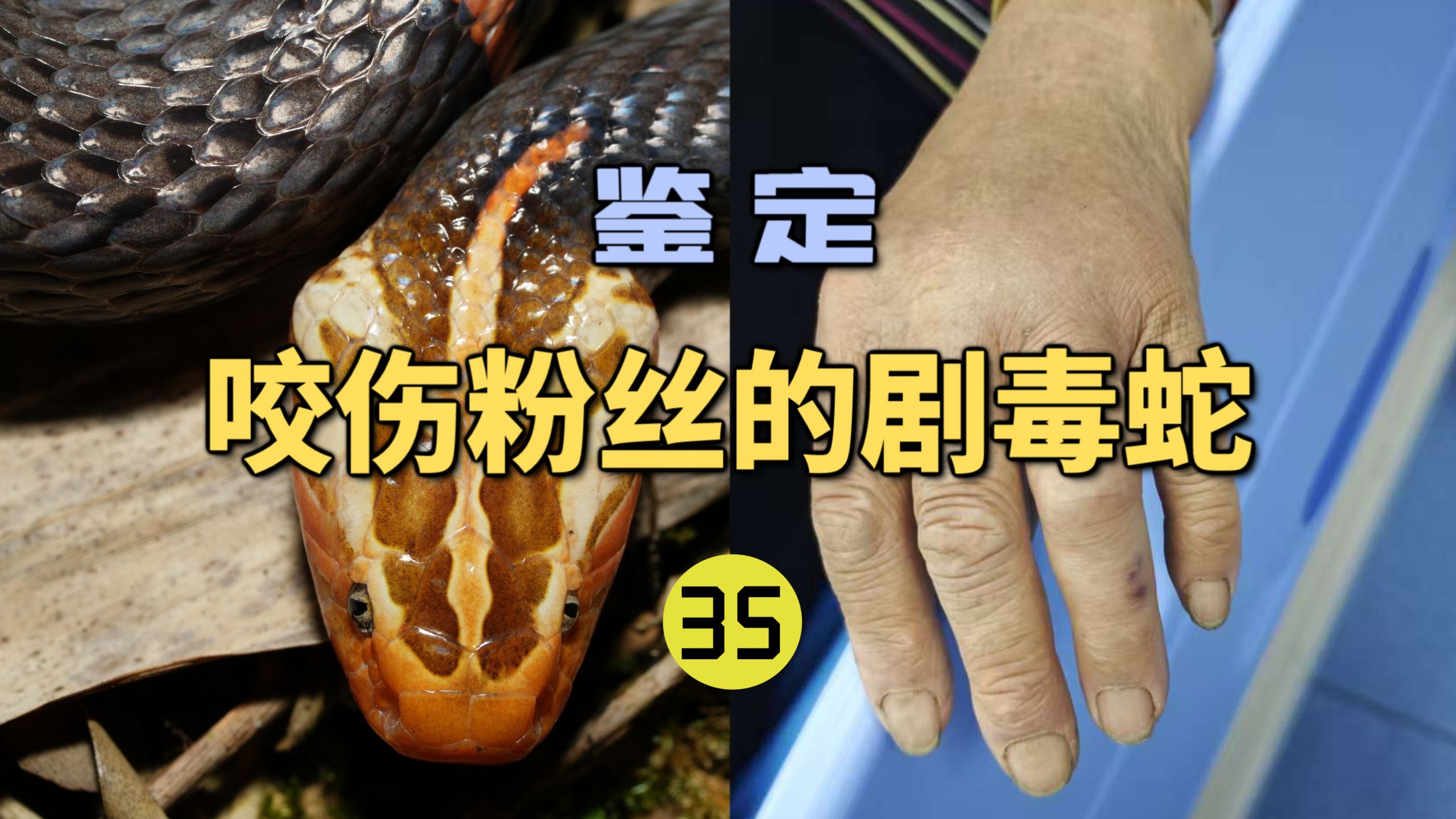 鉴定咬伤粉丝的毒蛇(35)号称“中国第一毒蛇”的白头蝰咬伤到底有多严重？
