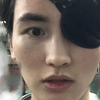一只眼睛被近视激光手术打残 只赔了七万元