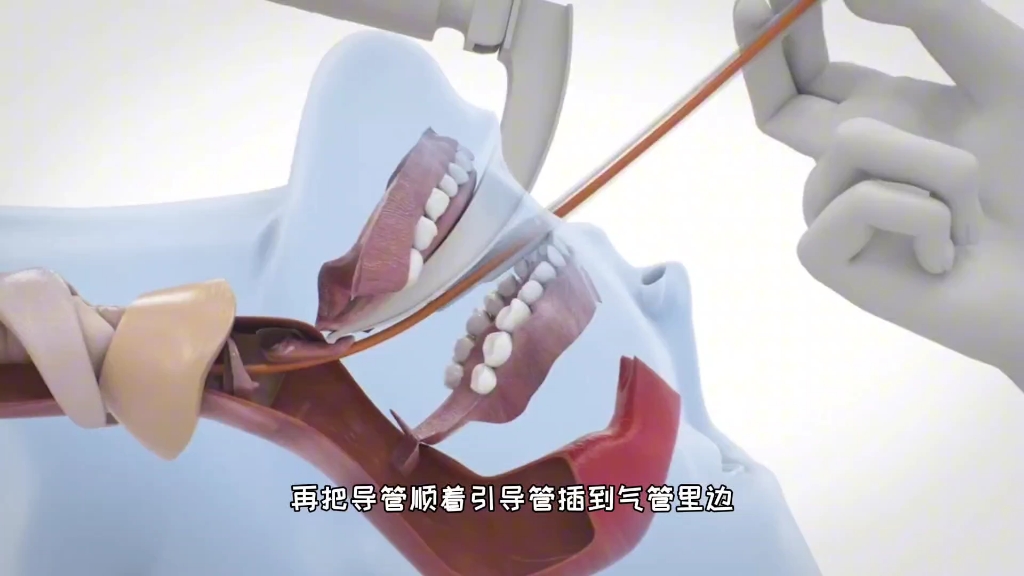 全麻手术人怎么通气，气管插管的过程，3D演示。。
