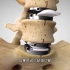 人工椎间盘置换手术的优缺点，3D演示。。