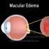 Macular Edema, Animation - 黄斑水肿的动画演示