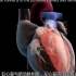 3D动画演示心脏主动脉瓣置换手术,现代医学技术果真发达