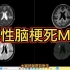 影像报告解读：急性脑梗死MRI表现讲解，简单易懂，收藏学习！