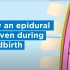 分娩时硬膜外麻醉怎么做？| 医学动画