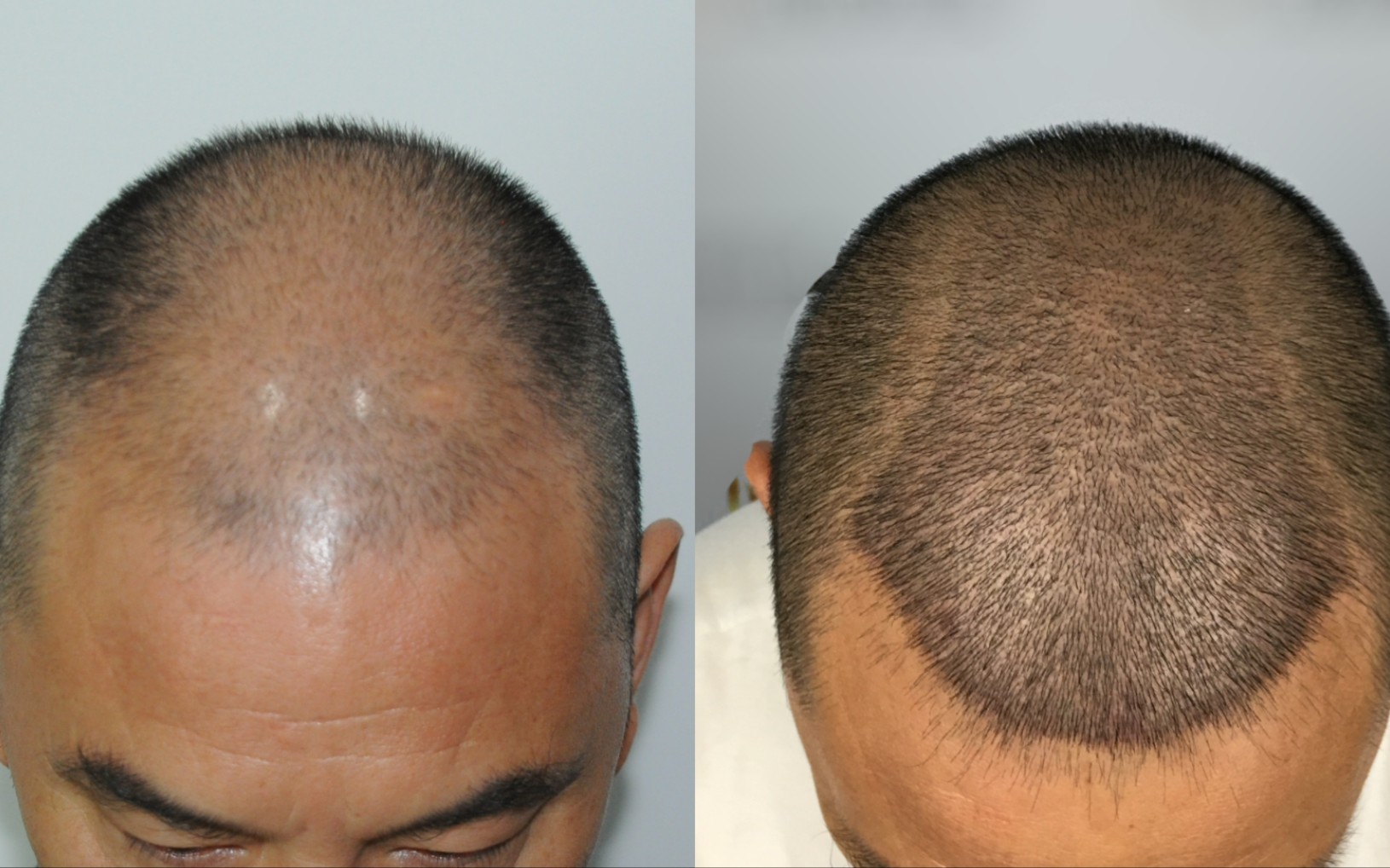 植发一年分享，花2万植发改善秃顶的效果