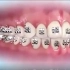 3D动画：牙齿矫正器原来是这样安上去的！