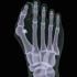 3D医学视频：拇指外翻的形成和解决方案
