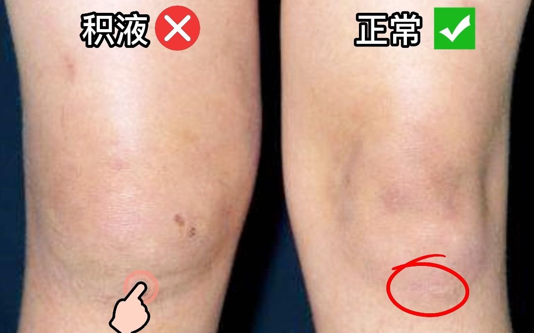 膝盖下方肿胀有积液，这个手法简单有效