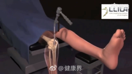 3D动画演示增高手术全过程