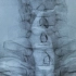 吴春根介入案例61 颈椎网袋辅助经皮椎体成形术