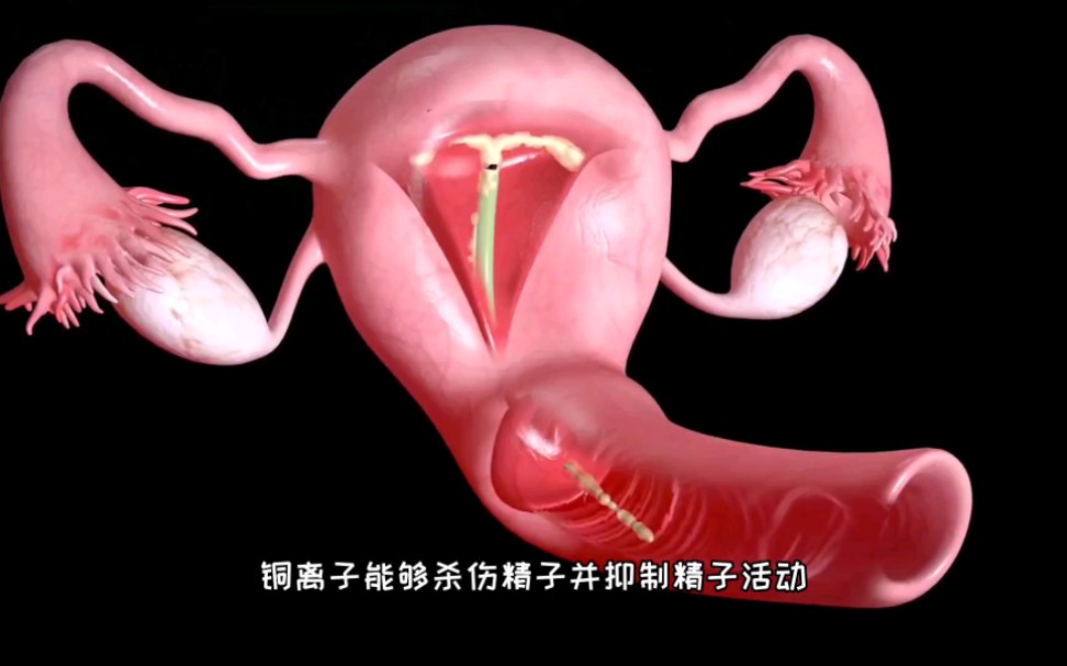 子宫宫内节育器的避孕原理，3D演示。。