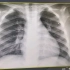 现在甲流比较多，支气管炎、支气管肺炎 、肺部感染的平片如何看？