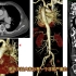 急性大血管疾病：主动脉夹层在CT上什么表现？专科医生讲解