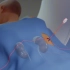 这么疼，肾穿刺活检过程，3D演示。。