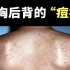 皮肤学博士教你：前胸后背的“痘痘”怎么处理？照着这个视频做就能搞定