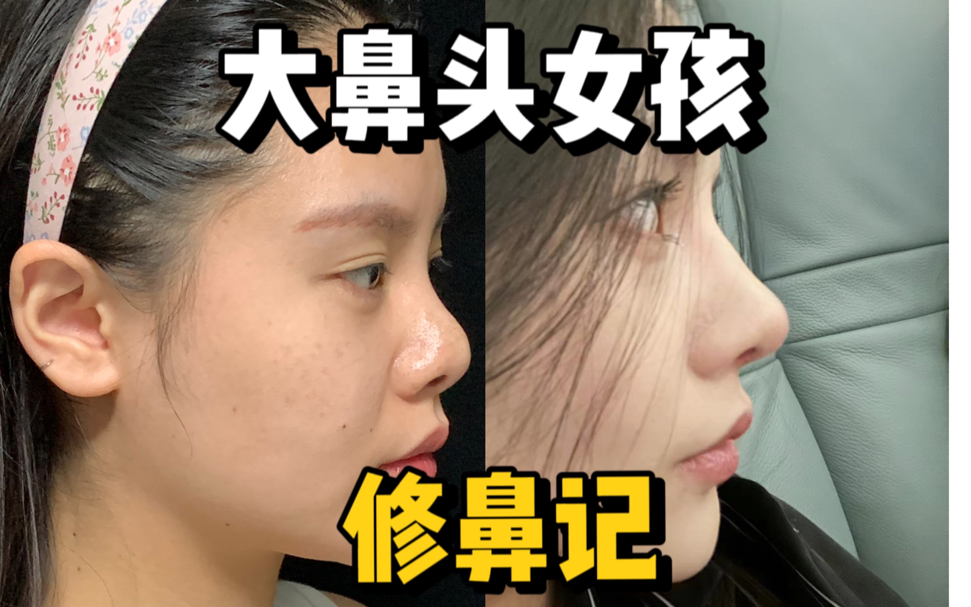 大鼻头该怎么改善呢？
