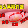 自测请进：除了艾滋，如何判断自己有没有感染性病